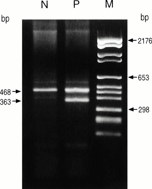 Fig. 2. Analysis of RT-PCR products from lymphocyte mRNAs. Amplified fragments encompassing exon 5, exon 6, and the coding part of exon 7 were obtained from lymphocyte cDNAs by RT-PCR using primers HUCO-2-Bio-A and HUCO-10S (9) and analyzed on 2% agarose gel. Two amplified products were obtained from the heterozygous harderoporphyric patient (P), the 468-bp fragment containing the K404E missense mutation and the 363-bp fragment resulting from the mRNA with complete deletion of exon 6. Amplification of control mRNA (N) showed only the normal 468-bp fragment. M, molecular size markers.