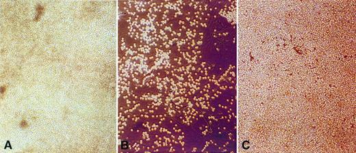 Fig. 4. Clusters of Burkitt's lymphoma cells adhere to and proliferate on HIV-1–infected MVEC from autologous human BM (A) and heterologous human brain (C) but not on uninfected brain MVEC (B). (A) Lymphoma cells and stromal cells in (A) were derived from the BM of an HIV-1 seropositive lymphoma patient. The lymphoma cells were EBV−, contained a t(8;14) chromosomal translocation, and proliferated spontaneously in stromal cell cultures that supported MVEC survival. (B) Lymphoma cells from (A) were transferred to pure brain MVEC monolayers. A small percentage of lymphoma cells adhered to brain MVEC, but these brain MVEC did not support sustained adhesion and growth of lymphoma cells. (C) Lymphoma cells from (A) were transferred to pure brain MVEC monolayers infected with HIV-1. Infected MVEC supported the long-term adherence and growth of lymphoma cells.