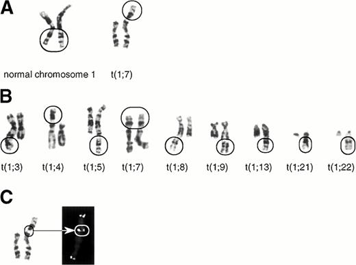 Fig. 1. The karyotypes of the jumping translocation. (A) The normal 1q21-ter (left) and the fused 1q21-ter onto the telomere of 7p (right). (B) Other fused 1q21-ter onto the telomeres of a variety of chromosomes (3q, 4p, 5q, 7p, 8q, 9q, 13q, 21q, and 22q). (C) FISH using the telomeric repeat, (TTAGGG)n. The twin spot signals at the fusion point of der(7)t(1;7)(q21;p22) are indicated by an arrow.