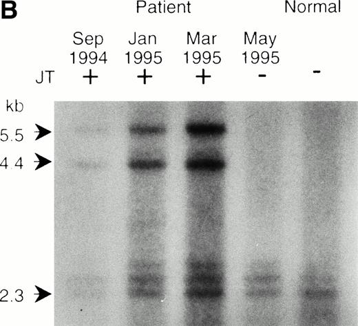 Fig. 2. Southern blot analysis of the jumping translocation. (A) BAL31 exonuclease treatment of normal genomic DNA. A longer incubation time with BAL31 exonuclease (indicated in minutes at the top of the lanes) reduces the signal of the terminal telomeric repeat and results in the appearance of the internal TTAGGG-fragments. (B) Southern blot analysis of DNAs from the JT patient and a normal individual using the telomeric repeat as a probe. The DNAs were digested with BAL31 exonuclease, followed by the Hinf I restriction. Arrows indicate the JT-specific fragments (4.4 kb and 5.5 kb). (C) Southern blot analysis of DNAs from the patient and a normal individual using the nontelomeric probe A (see Fig 3a). The DNAs were digested withEcoT14 I. Arrows indicate the JT-specific fragments (6.0 kb and 7.0 kb). The arrowhead indicates the fragment derived from the normal allele (2 kb).