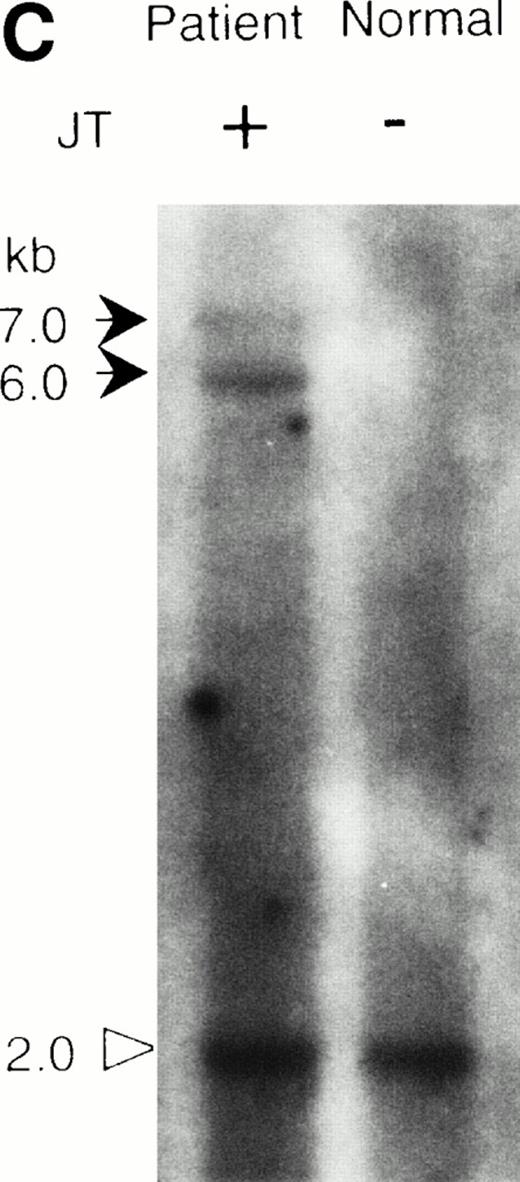 Fig. 2. Southern blot analysis of the jumping translocation. (A) BAL31 exonuclease treatment of normal genomic DNA. A longer incubation time with BAL31 exonuclease (indicated in minutes at the top of the lanes) reduces the signal of the terminal telomeric repeat and results in the appearance of the internal TTAGGG-fragments. (B) Southern blot analysis of DNAs from the JT patient and a normal individual using the telomeric repeat as a probe. The DNAs were digested with BAL31 exonuclease, followed by the Hinf I restriction. Arrows indicate the JT-specific fragments (4.4 kb and 5.5 kb). (C) Southern blot analysis of DNAs from the patient and a normal individual using the nontelomeric probe A (see Fig 3a). The DNAs were digested withEcoT14 I. Arrows indicate the JT-specific fragments (6.0 kb and 7.0 kb). The arrowhead indicates the fragment derived from the normal allele (2 kb).