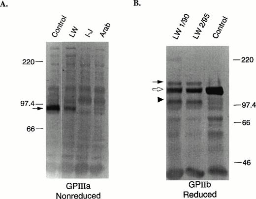 Fig. 1. Immunoblot analyses of GPIIIa (nonreduced) and GPIIb (reduced). SDS-solubilized platelets (1 μL of 5 × 107platelets/mL) were electrophoresed into a 7.5% polyacrylamide gel, electrotransferred onto PVDF membranes, and developed as previously described.31 (A) Control, patient, and two other GT patient samples with mutations in GPIIIa (I-J: Iraqi-Jewish) and GPIIb (Arab)44 were run under nonreduced conditions. The membranes were incubated with the anti-GPIIIa specific murine MoAb, 7H2.29 The arrow indicates the position of GPIIIa. (B) Two patient samples prepared on different dates (January 1990 and February 1995) and a control sample were run under reduced conditions. The membranes were incubated with the anti-GPIIb heavy chain specific murine MoAb, PMI-1.3233 The solid arrow indicates the position of proGPIIb, the open arrow, mature processed GPIIb, and the arrow head an abnormally migrating fragment.