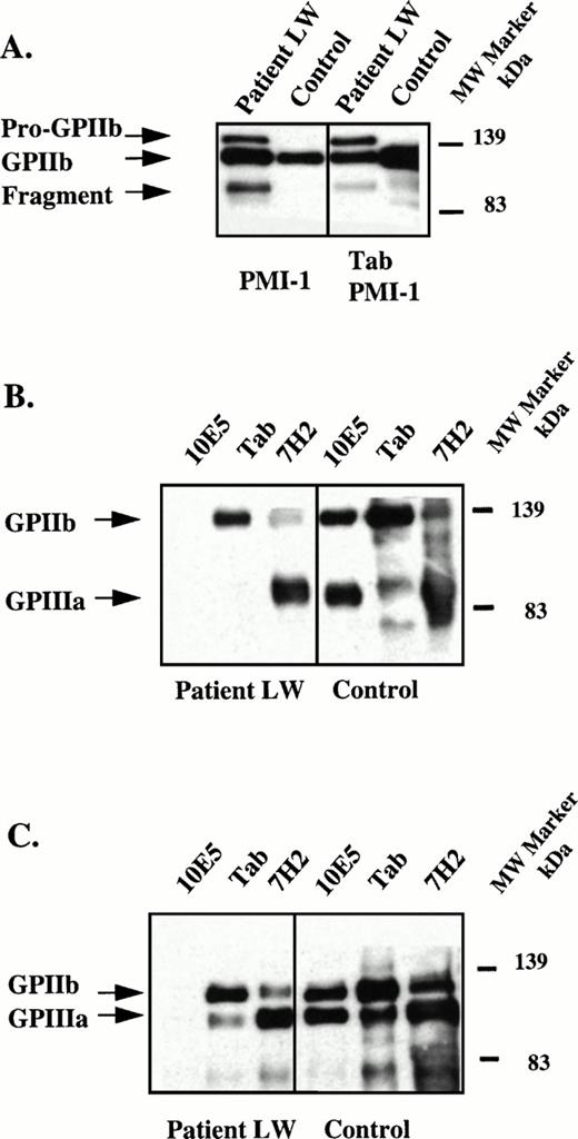 Fig. 2. Immunoblot and immunoprecipitation of solubilized, surface-biotinylated platelets. (A) Left panel, immunoblot of patient and control platelet lysates using the GPIIb-specific MoAb, PMI-1.3233 This pattern is essentially identical to that in Fig 1 except that because the control sample was diluted 20-fold, the bands in the patient's sample are more intense than the bands in the control sample. Right panel, immunoprecipitation of lysates using the GPIIb-specific MoAb, Tab34 and immunoblotting with PMI-1. Samples were electrophoresed under reduced conditions and arrows mark the positions of pro-GPIIb, mature GPIIb, and the GPIIb fragment. These data indicate that Tab recognizes all forms of the mutant GPIIb. (B) Patient and normal control surface-biotinylated platelet lysates were immunoprecipitated with the GPIIb/IIIa complex-specific MoAb, 10E5,26 the GPIIb-specific MoAb, Tab, and the GPIIIa-specific MoAb, 7H2.29 Immunoprecipitates were electrophoresed under nonreduced conditions and blotted onto PVDF membranes. The membranes were treated with HRP-streptavidin and the bands developed. Arrows mark the positions of GPIIb and GPIIIa. Because only surface-labeled molecules are detected by the avidin reagent, the failure to identify the patient's abnormal GPIIb bands indicates that these were not present on the surface of the patient's platelets. (C) Experiment conducted as in (B) except immunoprecipitates were reduced before electrophoresis.