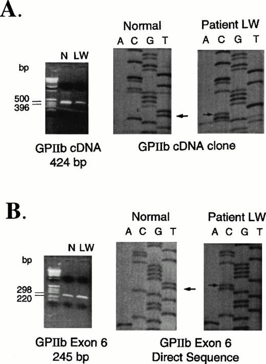 Fig. 3. PCR-amplified fragments and sequence analyses of control and patient RNA and DNA samples. (A) RT-PCR amplification of RNA extracted from normal control (N) and patient (LW) platelets. Using primers A and C (Table 1), a 424-bp fragment was cloned and sequenced. Arrows indicate the T (normal) to C (patient) nucleotide base change. (B) PCR amplification of DNA extracted from peripheral mononuclear cells isolated from a normal control (N) and the patient (LW). Using primers specific for amplification of GPIIb exon 6, the 245-bp fragments were directly sequenced as described previously. Arrows indicate the T (normal) to C (patient) nucleotide base change. No normal sequence was identified in the patient's DNA.