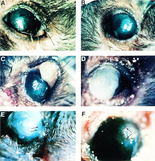 Fig. 2. Photomicrographs of gross pathology of ligneous lesions in Plg−/− mice, showing mild and severe manifestations. (A) Thickened eyelid representing an early or mild lesion. Note that the observed cataract formed postmortem. (B) Stromal haze and epithelial defect; (C) pedunculated lesion in the upper lid, with ulceration and hemorrhage in the lower lid; (D) plaque extending above the corneal surface; (E) neovascularization of the cornea extending from the limbus into the plaque (arrows); and (F) corneal neovascularization around the circumference of a plaque (arrows).