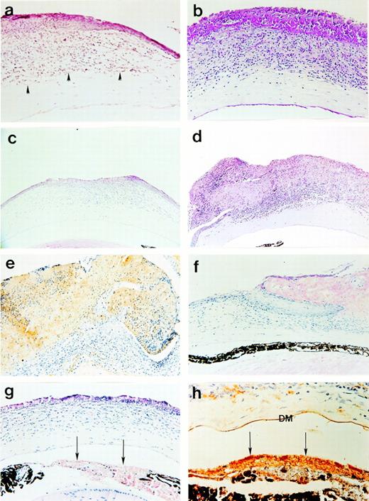 Fig. 5. Photomicrographs of corneal lesions in Plg−/− mice. (a) Stromal vascularization (arrowheads) in regions underlying extended plaques; (b) Extensive cellular infiltration and anterior deposition of PAS+ material, yet relatively normal posterior stroma with only mild inflammatory infiltration; (c) corneal ulceration; (d) An extensive corneal plaque which contained (e) abundant fibrin(ogen) matrix; (f) Formation of a wedge-like projection of epithelial cells was identified underlying but not penetrating the shoulder region of a plaque. The acellular, eosinophilic material above the “wedge” appeared to bisect the epithelial layer, leaving a thin layer of necrotic squamous cells exposed. (g) A pupillary membrane (arrows) formed in mice with severe corneal lesions. (h) This aberrant membrane stained intensely for fibrin(ogen) (arrows) by immunohistochemistry (DM denotes Descemet's membrane). Panels a, c, d, f, and g are hematoxylin- and eosin-stained, panel b is PAS-stained, and panels e and h are fibrin(ogen) immunohistochemistry. Original magnifications are 100× (panels c and d), 200× (panels a, b, e, f, and g) and 400× (panel h).