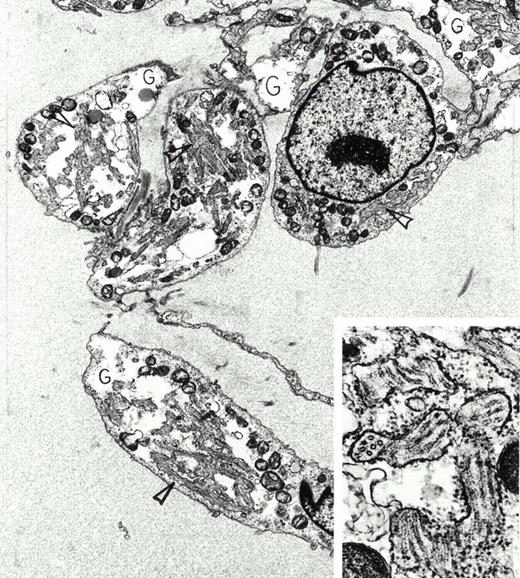 Extraskeletal myxoid chondrosarcoma. A 72-year-old asymptomatic man was found to have a large mass in the thigh by physical examination. This was removed surgically, and radiation therapy was administered to the area. Despite multiple bilateral, slowly enlarging pulmonary metastases, he remained in good health 4 years later. Immunoperoxidase stains of the tumor were positive for vimentin and negative for actin, desmin, myoglobin, S-100 protein, keratin, and epithelial membrane antigen. By electron microscopy, the tumor was composed of interconnected chains of plump polygonal and elongate spindle cells in an abundant edematous matrix. Tumor cells were focally invested in basal lamina, displayed large, electron-lucent, cytoplasmic glycogen pools (G) and extensive enlarged cisterns of rough endoplasmic reticulum packed full with tubules (arrowheads). This tubular array is seen at higher magnification and in both longitudinal and cross-sectional views in the inset. Original magnification ×8,000 (inset, ×59,000). (Courtesy of Ann M. Dvorak, MD, Department of Pathology, Beth Israel Deaconess Medical Center, 330 Brookline Ave, Boston, MA 02215.) {/ANNT;80256n;;center;0n}