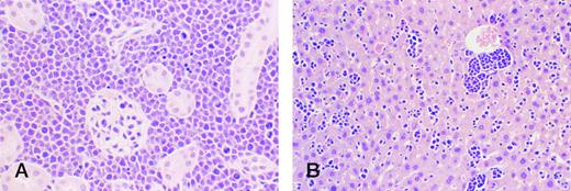 Fig. 2. BCP-1 cells circulating through and forming microscopic tumor deposits in kidney (A) and liver (B) after ip inoculations in Nod/SCID mice. Mitotic figures are prominent.