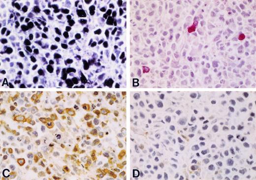 Fig. 3. Solid lymphoma established in Nod/SCID mouse after iv injection with HBL-6 cells. (A) EBER ISH showing intense localization of signal (black chromagen) in nuclei of tumor cells indicating coinfection by EBV (60× magnification). (B) Polyclonal rabbit antiserum against KSHV vIL-6. A minority of cells express detectable protein (red chromagen), which is restricted to the cytoplasmic compartment (with exclusion of nuclei). (60× magnification; Mayer's hematoxylin counterstain). (C) EMA is strongly expressed in anaplastic tumor cells characterized by large pleomorphic nuclei and abundant mitotic activity (60× magnification; Mayer's hematoxylin counterstain). (D) Leukocyte common antigen (LCA) is not generally expressed in tumor cells consistent with the null immunophenotype association with PEL and derived cell lines (60× magnification; Mayer's hematoxylin counterstain).