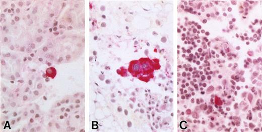Fig. 4. KSHV+ cells are present in various mouse organs after iv injections of KSHV+ cells. (A) Mouse kidney with rare vIL-6+ (BCP-1) cells infiltrating parenchyma. (B) KSHV vIL6+ BCP-1 cells in retroperitoneal fat. (C) Mouse thymus showing numerous small mouse lymphocytes with a small population of larger BCP-1 cell infiltrate, one stained positive for vIL-6.