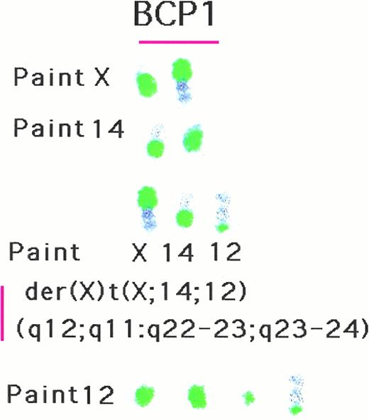 Fig. 9. Chromosome painting for chromosomes X, 12, and 14 showed that the der(x) correspond to t(x;14,12) (q12; q11:q22-23; q23-24).