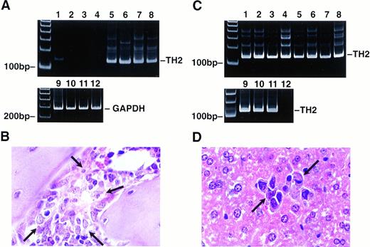 Fig. 2. Demonstration of established bone marrow and liver metastasis after intravenous injection of 5 × 104 NXS2 cells by histology and tyrosine hydroxylase RT-PCR. Mice (n = 8) were killed 5 days after intravenous injection with 5 × 104NXS2 cells. Bone marrow (A and B) and liver (C and D) specimens were analyzed by tyrosine hydroxylase– nested RT-PCR (A and C, top) and histology (B and D). The presence of a TH2 signal indicates NXS2 infiltration into bone marrow (A) or liver (C). GAPDH was amplified with probes lacking a TH2 signal to prove cDNA integrity (A, bottom). A sensitivity of one tumor cell in 106hepatocytes was established with tyrosine hydroxylase–nested RT-PCR of NXS2 cells in liver tissue was established with reciprocal tumor to liver cell ratios of 1:104 to 1:107 (C, lanes 9 to 12). Paraffin-embedded sections of bone marrow and liver specimen were stained with hematoxylin/eosin. Arrows indicate focal tumor cell infiltrates photographed at 1,000 × magnification (oil immersion).