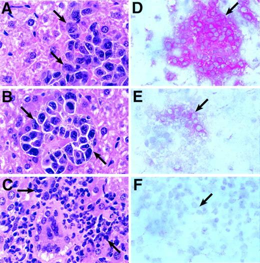 Fig. 3. Histological and immunohistochemical analyses of tumor-bearing mice after fusion protein therapy. Five days after intravenous inoculation with 5 × 104 NXS2 cells, mice with established liver metastases were treated by daily (×5) intravenous injections of either 10 μg ch14.18–IL-2 fusion protein, an equivalent mixture of 10 μg ch14.18 and 30,000 IU rhIL-2, or PBS (pH 7.4). Twenty-four hours after completion of treatment, paraffin-embedded sections of livers from either PBS (A), IL-2/antibody mixture (B), and fusion protein (C) treated animals were stained with hematoxylin/eosin. Tumor foci or infiltrates are depicted at a magnification of 1,000×. Arrows delineate tumor foci (A and B) or inflammatory cells (C). Frozen liver sections of mice treated with fusion protein were stained with monoclonal anti-leukocyte CD45 antibody (D), anti-asialo GM1 antiserum (E), and monoclonal anti-CD8 antibody (F). Red cells indicate positive staining for each marker.