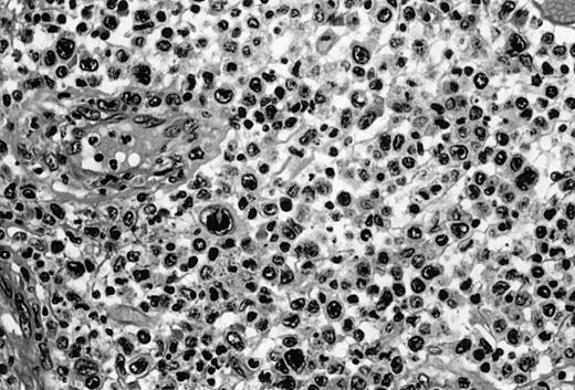 Fig. 1. Pleomorphic large-cell γδ T-cell lymphoma (case no. 3) (nasal biopsy specimen with hematoxylin-eosin stain).