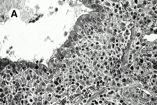 Fig. 2. Pulmonary pleomorphic large-cell γδ T-cell lymphoma (case no. 4). (A) Atypical lymphoid cells involve the bronchiolar wall and epithelium; (B) features of angioinvasion; note the preservation of alveolar structures (lung biopsy specimen with hematoxylin-eosin stain); (C) neoplastic cells strongly express TCR γδ. (Immunohistochemical staining on frozen sections with anti-δTCR1 antibody, APAAP technique.)