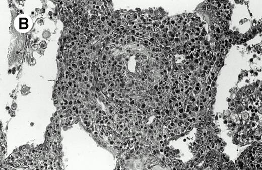Fig. 2. Pulmonary pleomorphic large-cell γδ T-cell lymphoma (case no. 4). (A) Atypical lymphoid cells involve the bronchiolar wall and epithelium; (B) features of angioinvasion; note the preservation of alveolar structures (lung biopsy specimen with hematoxylin-eosin stain); (C) neoplastic cells strongly express TCR γδ. (Immunohistochemical staining on frozen sections with anti-δTCR1 antibody, APAAP technique.)