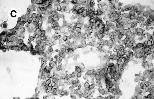 Fig. 2. Pulmonary pleomorphic large-cell γδ T-cell lymphoma (case no. 4). (A) Atypical lymphoid cells involve the bronchiolar wall and epithelium; (B) features of angioinvasion; note the preservation of alveolar structures (lung biopsy specimen with hematoxylin-eosin stain); (C) neoplastic cells strongly express TCR γδ. (Immunohistochemical staining on frozen sections with anti-δTCR1 antibody, APAAP technique.)