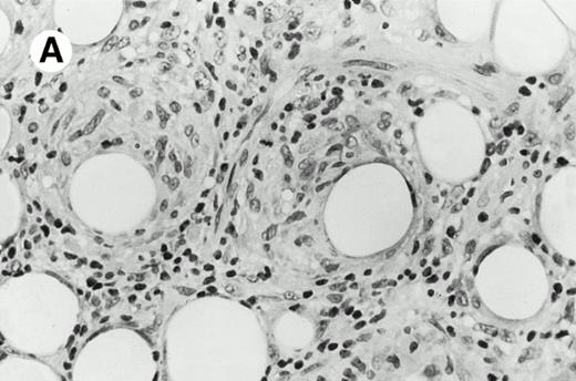 Fig. 3. Subcutaneous γδ T-cell lymphoma (case no. 6). (A) Initial biopsy sample shows characteristic features of cytophagic histiocytic panniculitis without evidence of lymphoma cells; (B) second biopsy performed 7 months later demonstrates involvement of the subcutaneous tissue by a pleomorphic γδ T-cell lymphoma (hematoxylin-eosin stain).