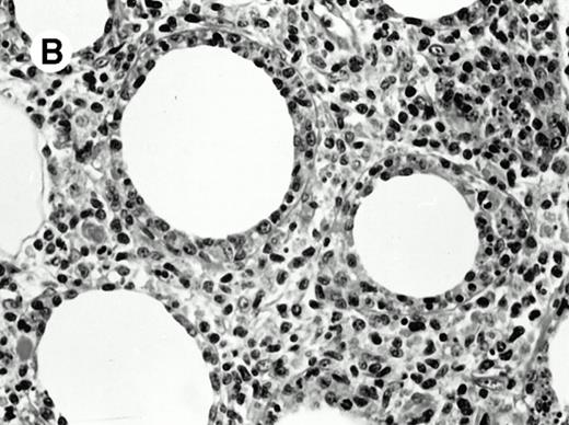 Fig. 3. Subcutaneous γδ T-cell lymphoma (case no. 6). (A) Initial biopsy sample shows characteristic features of cytophagic histiocytic panniculitis without evidence of lymphoma cells; (B) second biopsy performed 7 months later demonstrates involvement of the subcutaneous tissue by a pleomorphic γδ T-cell lymphoma (hematoxylin-eosin stain).