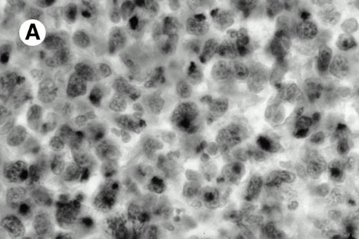Fig. 4. Granzyme B expression. (A) Strong paranuclear staining of neoplastic cells in a nasal lymphoma (case no. 3); (B) strong cytoplasmic staining of a few neoplastic cells surrounding intestinal glands in an enteropathy-associated γδ T-cell lymphoma (case no. 11). (Paraffin-embedded section, APAAP technique.)