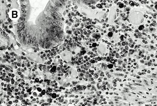 Fig. 4. Granzyme B expression. (A) Strong paranuclear staining of neoplastic cells in a nasal lymphoma (case no. 3); (B) strong cytoplasmic staining of a few neoplastic cells surrounding intestinal glands in an enteropathy-associated γδ T-cell lymphoma (case no. 11). (Paraffin-embedded section, APAAP technique.)
