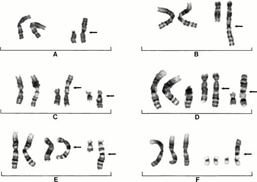 Fig. 1. Partial karyotypes from six different patients showing examples of recurring 1q aberrations seen in MM. Patient No.14 showing normal chromosomes 1 on left and der(15)t(1;15)(q10;q10) on right (A). Patient No. 7 showing normal chromosomes 1 on left and der(12)t(1;12)(q10;q24) on right (B). Patient No. 4 showing normal chromosomes 1 on left, der(8)t(1;8)(q10;p23) in middle, and der(16)t(1;16)(q10;p10) on right (C). Patient No. 1 showing two normal chromosomes 1 and an extra copy of 1q on left, a der(5)t(1;5)(q10;q15) in the middle, and der(16)t(1;16)(q10;p13) on right (D). Patient No. 2 showing der(5)t(1;5)(q10;q15) in middle and der(17)t(1;17)(q10;q25) on right (E). Patient No. 21 showing three chromosomes 1 on left with three normal copies of chromosome 19 and a der(19)t(1;19)(q10;p13) on right (F). Arrows indicate chromosome fusion points.