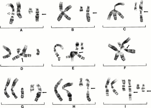Fig. 2. Partial karyotypes of nine different cells from patient No. 3 showing centromeric heterochromatin decondensation of chromosome 1 and association of 1q heterochromatin with 17q25. Duplications of 1q (open arrow) are found in addition to extra copies of translocated 1q (closed arrow) (A). Subtle decondensation of chromosomes 1 and crossing over of chromosomes 1 (B and C). Crossing over of der(17)t(1;17)(q10;q24) with chromosome 1 (arrows) (D and E). An extra free copy of 1q (G). Decondensation of chromosome 1 and der(17) (H). Chromosome 1q has jumped from der(17) to 7q leaving heterochromatin on 17q24 (arrow) (I).