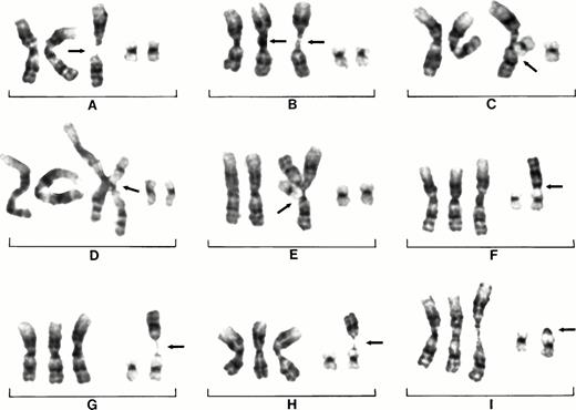 Fig. 3. Partial karyotypes of nine different cells from patient No. 22 showing centromeric heterochromatin decondensation of chromosome 1, formation of triradial configurations, and movement of 1q. Decondensation of centromeric heterochromatin and apparent separation of 1p and 1q of one chromosome 1 (arrow), normal chromosomes 19 on right (A). Decondensation of two chromosomes 1 (B). Decondensation of chromosomes 1 with chromosome 19p associating in region of decondensation (arrow) (C). Decondensation of 1qh and assocation of 19p13 with decondensed heterochromatin (arrow); note there are now four copies of 1q (D). Decondensation of 1qh and association of 19p13 with 1qh (arrow) and an extra copy of 1q. Note clear triradial of chromosome 1 (E). The translocation of 1q to 19p13 as it is seen in the vast majority of cells (F). The continuing instability of 1q is illustrated by the apparent decondensation of 1q sequences as it is lost from 19p (arrows); note thread-like chromatin. (G and H). The loss of 1q from 19p is shown by only heterochromatin remaining on 19p (arrow) (I). Note small segments of heterochromtin left on the short arm of 19 in cells (G and H).