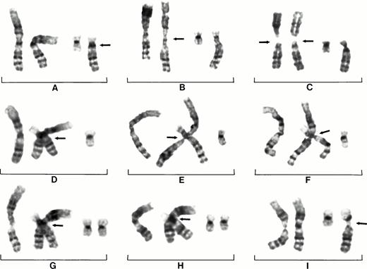 Fig. 4. Partial karyotypes of nine different cells from patient No. 26 showing centromeric heterochromatin decondensation of chromosomes 1, formation of triradial configurations, and movement of 1q. Cell showing normal 1s and der(19)t(1;19)(q10;p10) (arrow) (A). Chromosome 1 on right showing decondensation (arrow) (B). Both chromosomes 1 showing separations of short and long arms (arrows) (C). Somatic pairings of der (19)t(1;19)(q10;p10) and chromosomes 1 (arrows) (D through H). Subsequent instability of 19p10 and 1q10 (arrow) (I).
