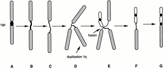 Fig. 5. Possible model for the decondensation of juxtacentromeric heterochromatin in jumping translocations of 1q. A spectrum of 1qh decondensations occur in MM cells, ranging from an apparently normal 1qh region (A), to slightly elongated 1qh (B), or highly decondensed and thread-like 1qh (C). Partial endoreduplication of 1q apparently occurs while heterochromatin is decondensed (D). Fusions with telomeres of nonhomologous chromosomes may be facilitated by the highly decondensed heterochromatin (E). The origin of a new derivative chromosome with 1q fused to telomere (F). Condensation of heterochromatin on derivative chromosome (G) creates the appearance of a typical whole-arm jumping translocation.