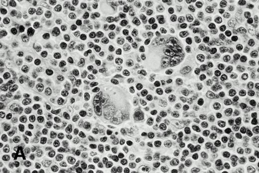 Fig. 1. H-RS cells in case 1 (A) and case 3 (B), (hematoxylin and eosin, original magnification × 400). H-RS cells were present among small lymphocytes in case 1, whereas they were present in a polymorphous inflammatory background in case 3.