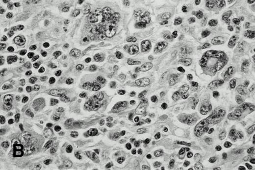 Fig. 1. H-RS cells in case 1 (A) and case 3 (B), (hematoxylin and eosin, original magnification × 400). H-RS cells were present among small lymphocytes in case 1, whereas they were present in a polymorphous inflammatory background in case 3.