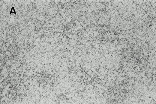 Fig. 2. Immunohistochemistry of CD3 in case 1: (A) low (40×), (B) high (400×). CD3+ T cells are associated with clusters of H-RS cells, often forming a ring around the H-RS cells. Inset shows CD30+ H-RS cells. Immunohistochemistry of MB2 in case 2: (C) low (40×), (D) high (400×). MB2+ CLL cells are present around a nodule of HD. H-RS cells are admixed with T cells and histiocytes and only scattered MB2+ small lymphocytes are present.
