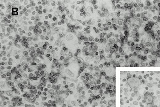 Fig. 2. Immunohistochemistry of CD3 in case 1: (A) low (40×), (B) high (400×). CD3+ T cells are associated with clusters of H-RS cells, often forming a ring around the H-RS cells. Inset shows CD30+ H-RS cells. Immunohistochemistry of MB2 in case 2: (C) low (40×), (D) high (400×). MB2+ CLL cells are present around a nodule of HD. H-RS cells are admixed with T cells and histiocytes and only scattered MB2+ small lymphocytes are present.