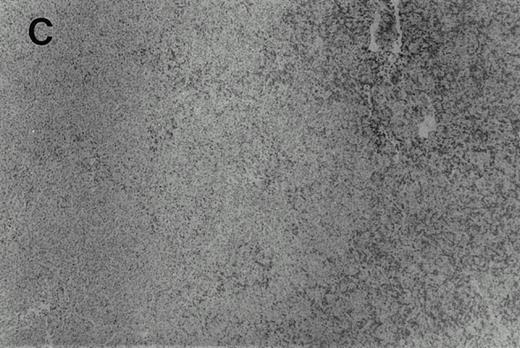 Fig. 2. Immunohistochemistry of CD3 in case 1: (A) low (40×), (B) high (400×). CD3+ T cells are associated with clusters of H-RS cells, often forming a ring around the H-RS cells. Inset shows CD30+ H-RS cells. Immunohistochemistry of MB2 in case 2: (C) low (40×), (D) high (400×). MB2+ CLL cells are present around a nodule of HD. H-RS cells are admixed with T cells and histiocytes and only scattered MB2+ small lymphocytes are present.