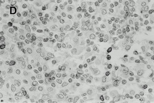 Fig. 2. Immunohistochemistry of CD3 in case 1: (A) low (40×), (B) high (400×). CD3+ T cells are associated with clusters of H-RS cells, often forming a ring around the H-RS cells. Inset shows CD30+ H-RS cells. Immunohistochemistry of MB2 in case 2: (C) low (40×), (D) high (400×). MB2+ CLL cells are present around a nodule of HD. H-RS cells are admixed with T cells and histiocytes and only scattered MB2+ small lymphocytes are present.