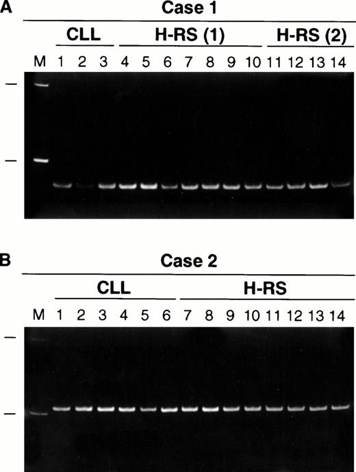 Fig. 3. Polyacrylamide gel electrophoresis of IgH CDRIII PCR products obtained from single CLL cells and H-RS cells: (A) case 1, (B) case 2. All PCR products are identical in size in each case. M, 100 basepair (bp) molecular size ladder with 100- and 200-bp markers shown. H-RS(1) indicates that the PCR products were obtained from CD30+ H-RS cells. In a separate experiment, CD20− H-RS cells were isolated for study and the PCR products are shown under H-RS(2).