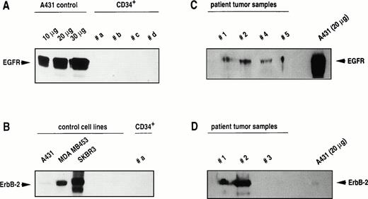 Fig. 1. Western blot analysis of Erb-B2 and EGF receptor expression in breast cancer cell lines, in CD34+ blood progenitor cells, and in primary tumor cells isolated from breast cancer patients. Total protein was extracted and 100 μg was run on a polyacrylamide gel unless otherwise indicated. After blotting, expression of Erb-B2 and EGF receptor was determined by staining with anti–Erb-B2 and anti–EGF receptor antisera as described in Materials and Methods.