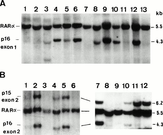 Fig. 1. (A) A representative film of Southern blot analysis onEcoRI-digested DNA from ALL patients showing homozygous deletion of p16 exon 1 on lanes 1, 2, 11, and 14; heterozygous deletion on lane 5; and rearrangement on lane 3. Normal control was shown on lane 6, K562 cell line on lane 7 (homozygous deletion), and HL60 on lane 8 (heterozygous deletion) for comparison. A retinoic acid receptor α (RARα) probe was used with p16 exon 1 probe simultaneously to clarify DNA quality and amount. (1B) Two representative films of Southern blot analysis using p16 exon 2 probe and EcoRI restriction enzyme showing homozygous deletion of p15 exon 2 on lanes 1, 6, 8, and 9 and that of p16 exon 2 on lanes 1, 6, 8, 9, 11, and 12. Normel control was shown on lane 2, K562 cell line on lane 3 (homozygous deletion of both genes), and HL60 on lane 4 (hererozygous deletion).