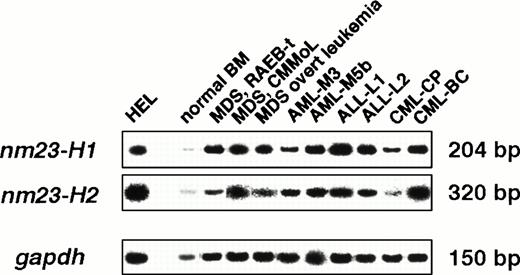 Fig. 2. Quantitative RT-PCR analysis of nm23-H1 andnm23-H2 mRNA in human normal BM cells, MDS, MDS overt leukemia, AML, ALL, CML-CP, and CML-BC samples. Normal BM cells were from normal volunteers. Neoplasm cells were identified as the mononuclear cell fraction.