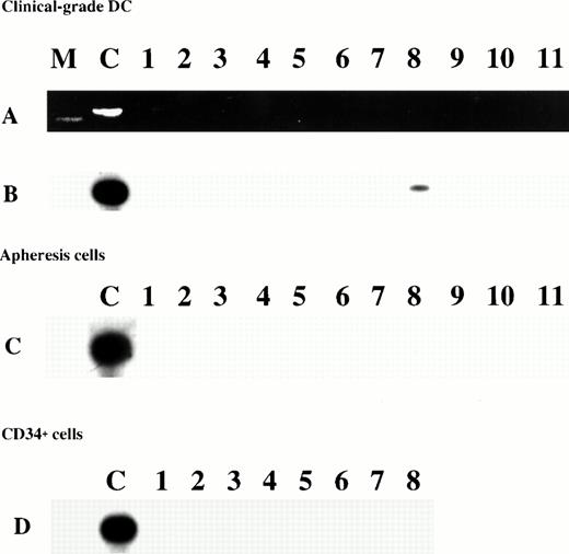 Fig. 5. PCR amplification of DNA from clinical-grade DC (A and B), from corresponding AC (C), and from CD34+ cells (D) from MM patients. (A) Ethidium bromide-stained agarose gel of the 233-bp amplification products. Lane M was a molecular size marker. (B, C, and D) Specific hybridization of the PCR products to a32P-end-labeled internal probe after transfer to a nylon membrane. The positive control (lane C) was the PCR product from the BCBL-1 cell line.
