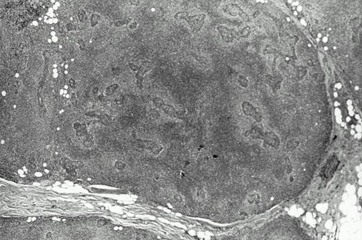 Fig. 1. Histologic features of the low grade salivary gland MALT lymphoma from patient JA. Note the halos of pale monocytoid cells around lymphoepithelial lesions on the right that become more confluent particularly on the left.