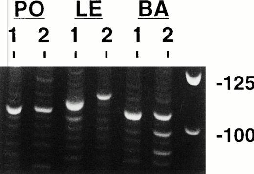 Fig. 2. PCR clonality analysis. Shown are representative products produced by amplifying paraffin-extracted DNAs from three cases with the consensus FW3 and JH1 primers after electrophoresis and ethidium bromide staining. Single clonal bands are seen in all of these specimens except in the second biopsy from patient BA, which shows multiple clonal bands. Molecular weight markers are shown in the left most lane. Each lower rung of the polyclonal background ladders represents 3 nucleotides or one amino acid.