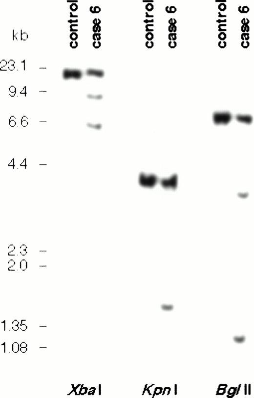 Fig. 6. Southern blot analysis of DNA from case no. 6 and normal control using probe X665. Two rearranged signals were seen inBgl II and Xba I digests, indicating that the breakpoint fell within the region of this probe in the 3′ UTR ofBCL9.
