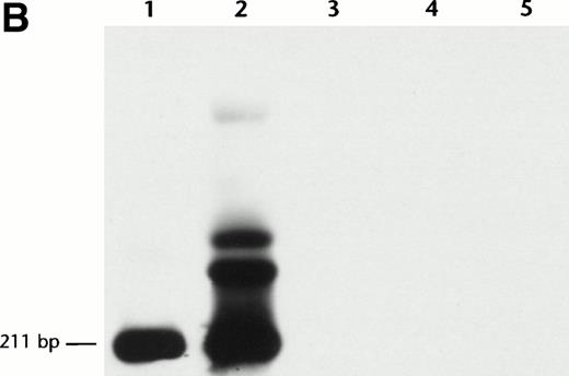 Fig. 3. Novel CBFB-MYH11 fusion in t(16;16) AML: PN 22. (A) Partial chimeric cDNA junctional sequence of 400-bp PCR product from PN 22. Sequencing was performed in both directions using primers C1 and M1. The new CBFB-MYH11 fusion site is shown by an asterisk at CBFB nt 455 and MYH11 nt 1893. The ORF is not disrupted by this fusion, but is 12 nt shorter than the type A fusion. (B) RT-PCR analysis confirming the presence of the new fusion type in PN 22 AML. PCR was performed using primers C1 and doM3′, followed by specific oligonucleotide hybridization (do probe), as described in the Materials and Methods. Lane 1, PCR amplification of reverse transcribed cDNA from PN 22 AML sample; lane 2, seminested PCR amplification from aliquot of first round C1-M1 PCR product of PN 22 sample; lane 3, AML-M4 sample lacking the inv(16)/t(16;16) andCBFB-MYH11 fusion by RT-PCR (this case not included in study group); lane 4, PN 11 sample with type A CBFB-MYH11 fusion by C1-M1 PCR; lane 5, negative control (noRNA).