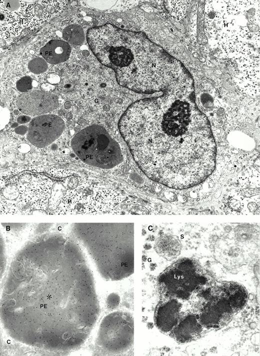 Erythrophagocytosis. Kupffer cell containing phagolysosomes is shown on a stained Epon section (A, original magnification ×10,500). Erythrophagocytosis is confirmed by an ultrathin frozen section which is labeled by a polyclonal rabbit antibody against human hemoglobin and immunogold particles showing that the electron dense bodies represent phagocytosed erythrocytes (B, original magnification ×41,000). Unstained Epon section reveals ferritin particles in the cytoplasm, a sidersome, and a lysosome of an adjacent hepatocyte which indicates iron overload (C, original mangification, ×58,000). H, hepatocyte; N, nucleus; G, Golgi complex; PE, phagocytosed erythrocyte; C, cytoplasm; G, glycogen particles; S, siderosome; Lys, lysosome. (Courtesy of K.-P. Zimmer, MD, Universitätskinderklinik, AlbertSchweitzer-Str. 33, D-48149 Münster, Germany.)