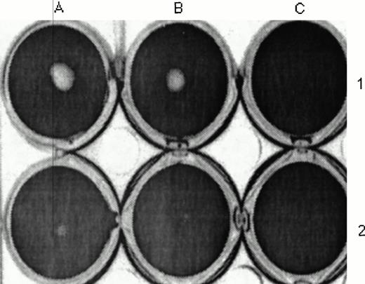Fig. 9. Effect of TF on uPA- and plasminogen-mediated fibrinolysis. scuPA (1 μmol/L) was added to a fibrin clot in PBS (A1 and B1) or PBS containing 14 nmol/L TF (A2 and B2) or TF without tcuPA (C1 and C2) for 2 hours. The clot was incubated with trypan blue, washed, photographed, and scanned, and its size was measured by densitinometric analysis as described in the Materials and Methods. The fibrin clot measured 0.75 and 0.84 cm2 in the absence of TF and 0.18 and 0.22 cm2 in the presence of TF. The data shown are representative of three experiments so performed. TF caused a similar increase in clot size when tcuPA (1 μmol/L) was substituted for scuPA.