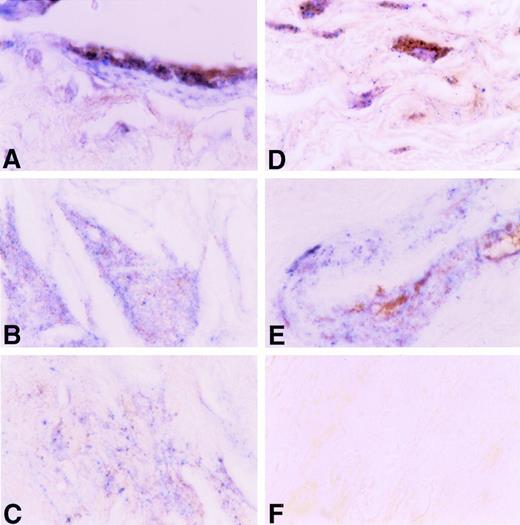 Fig. 12. Immunohistochemical colocalization of TF apoprotein and plasminogen in human atherosclerotic coronary artery. TF apoprotein stained blue; plasminogen stained brown (see the Materials and Methods). A large coronary artery is shown at an original magnification ×200. (A) Endothelial cells overlying plaque. (B) Acellular plaque with cholesterol cleft. (C) Acellular plaque matrix. (C) Adventitia. (E) Media of small artery within coronary artery. (F) Negative Ig control.