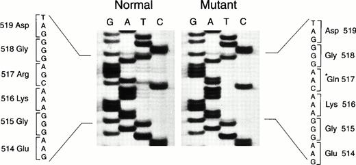 Fig. 2. Results of DNA sequencing. Nucleotide sequence for a portion of two clones obtained for prothrombin exon 13, which was amplified by PCR from DNA of the proband. Sequencing was by the dideoxy method of Sanger.21 The asterisk (*) indicates the mutated amino acid residue.