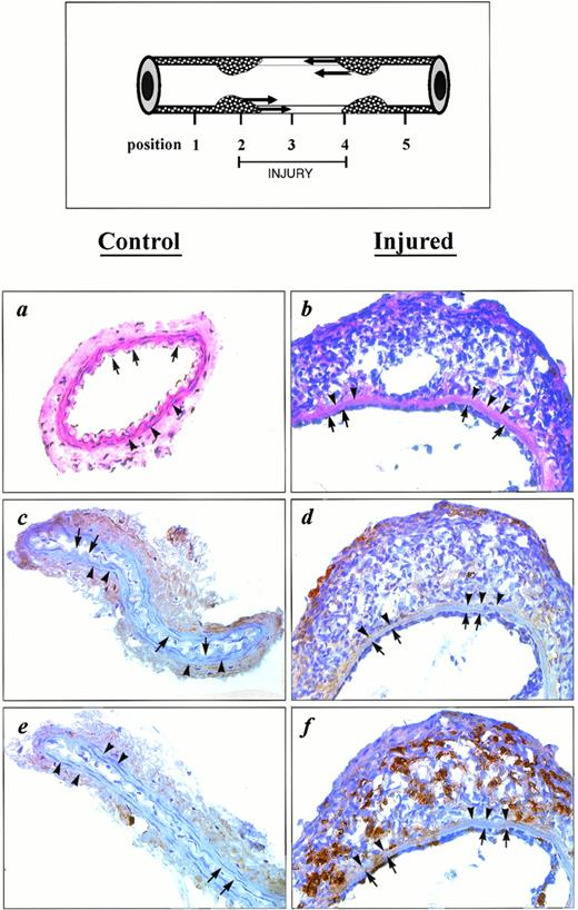 Fig. 1. Light microscopic analysis (original magnification ×200) of sections of noninjured control arteries and of sections taken from the center of injured arteries (position 3 in the inset) after 1 week in MMP-3−/− mice. Staining is performed with hematoxylin-eosin (panels a and b) or with antiserum against MMP-2 (panels c and d) or against MMP-9 (panels e and f). The inset shows a longitudinal section through the artery, and the arrows indicate the presumed migration of smooth muscle cells. Positions 1 and 5 correspond to normal sections, positions 2 and 4 to the borders of the injury, and position 3 to the center of the injury (modified from Carmeliet et al26). The arrows and arrowheads indicate the internal and external elastical lamina, respectively.